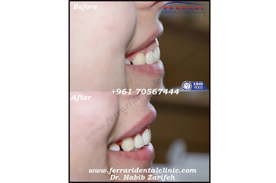 Gummy Smile correction for simple cases