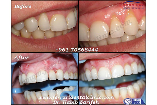 Dental Implants and gummy smile