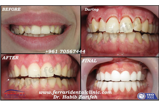 Hollywood smile and gummy smile